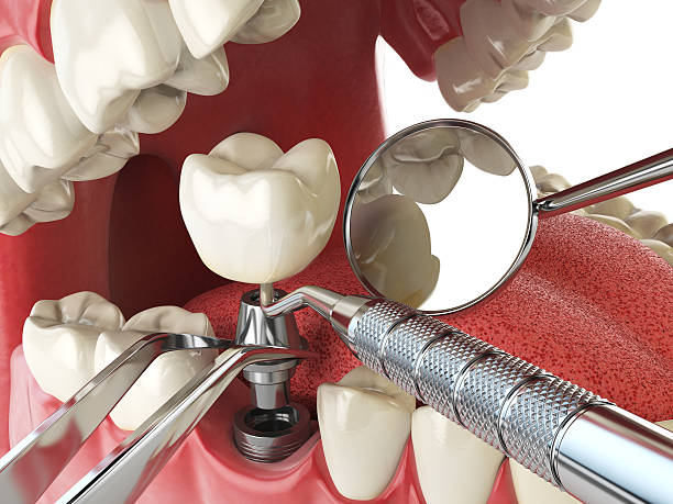 Best Emergency Wisdom Teeth Removal in Novato, CA